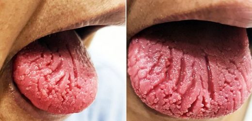 Woman, 60, suffers agonizing TONGUE ulcers after Pfizer COVID vaccine