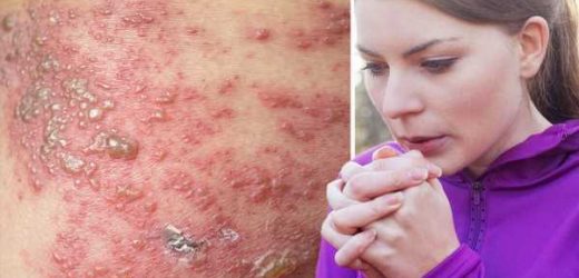 ‘Chilly’ sign you could have shingles and other symptoms