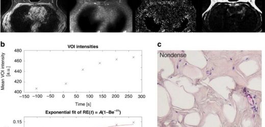A possible biological explanation for increased cancer risk in dense breasts