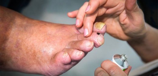 Changes in nails may be observed at ‘earliest stage’ of dementia