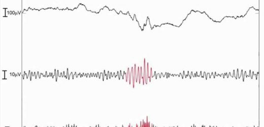 Machine learning predicts epileptogenic activity from high-frequency oscillation rates