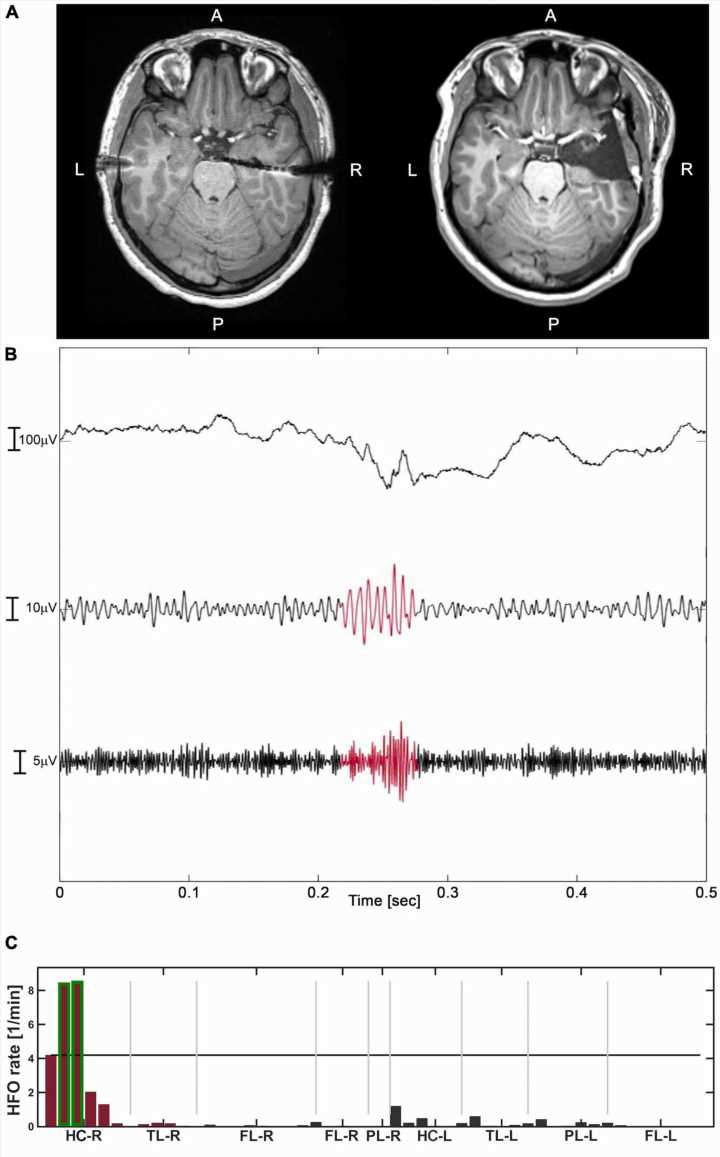 Machine learning predicts epileptogenic activity from high-frequency oscillation rates