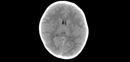 A Single Pediatric CT Scan Raises Brain Cancer Risk