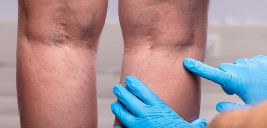 Cold temperatures can make you prone to blood clots, warns expert