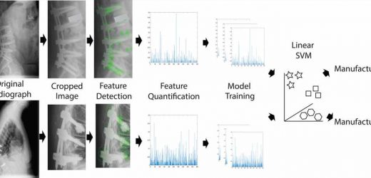 Computer vision is superior to surgeons in identifying spinal implants, shows study