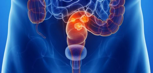 Rectal Cancer Survival Significantly Improved in Recent Years