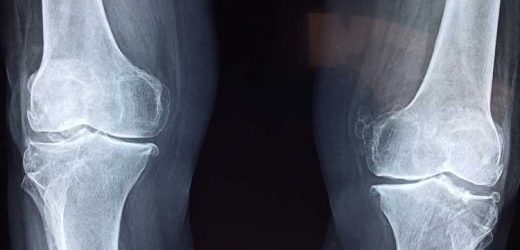 Reducing opioids prescribed after total knee and hip arthroplasty can be beneficial for patients and doctors