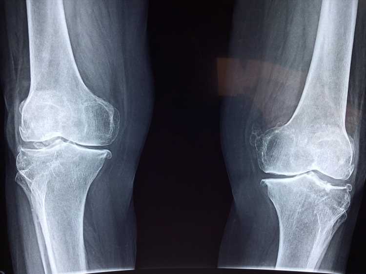 Reducing opioids prescribed after total knee and hip arthroplasty can be beneficial for patients and doctors