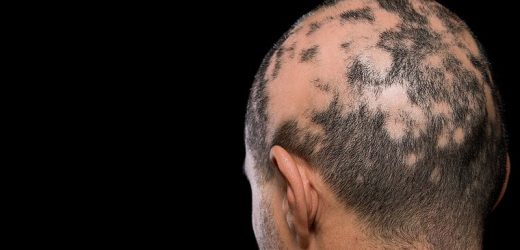 Study Evaluates Alopecia Areata Features in Hispanic Population