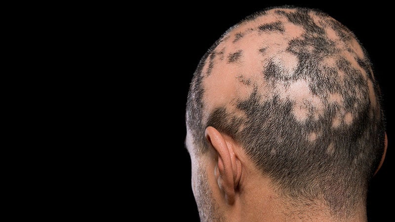 Study Evaluates Alopecia Areata Features in Hispanic Population