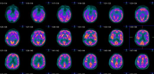 Tackling the ethical considerations of dementia research