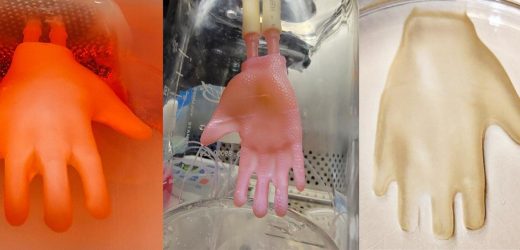 Bioengineered skin grafts that fit like gloves