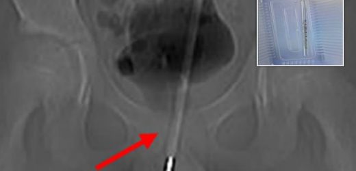 Chinese boy, 12, gets THERMOMETER stuck in his bladder
