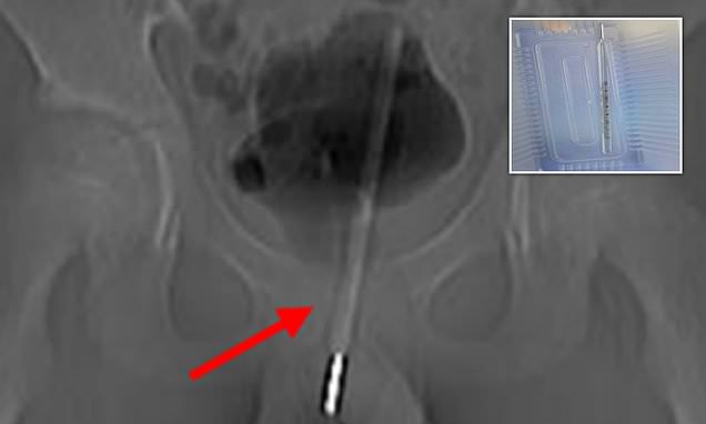 Chinese boy, 12, gets THERMOMETER stuck in his bladder
