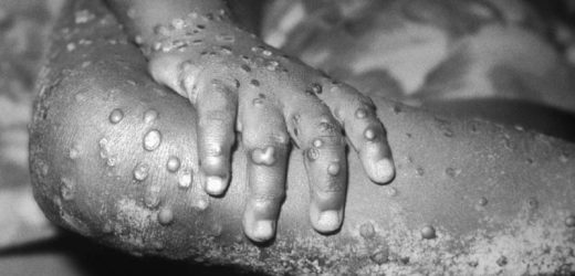 Mpox: Dermatology Registry Data Pinpoints Unique Signs