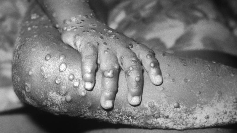 Mpox: Dermatology Registry Data Pinpoints Unique Signs