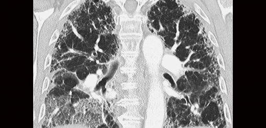 Neutrophil Test Found Useful for Predicting Survival in IPF