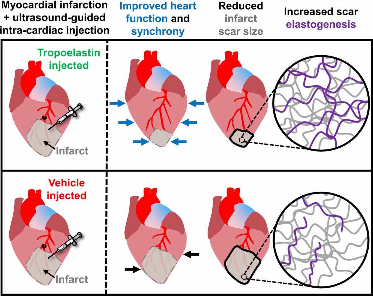 Scientists find way to heal scars left behind by heart attacks