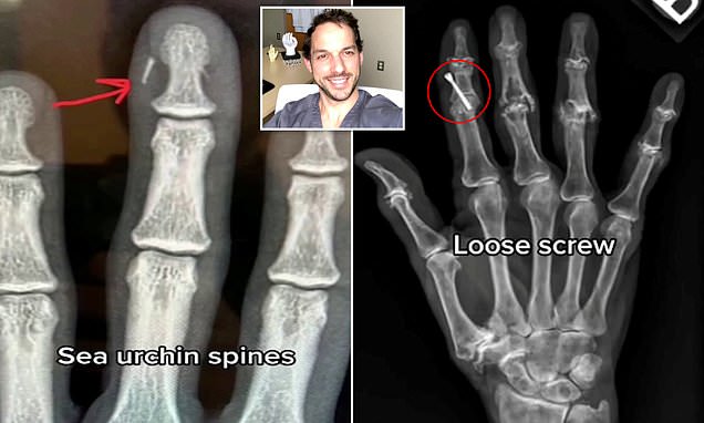 Surgeon reveals the weirdest things he&apos;s removed from people&apos;s hands