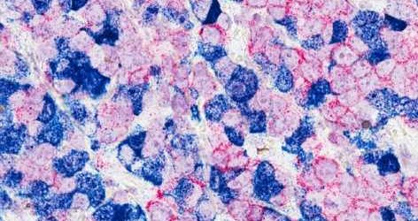 Targeting cancer-supporting cells boosts immunotherapy in previously insensitive tumors