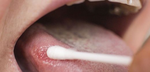 ‘Erythoplakia’ in the mouth that could signal a high cancer risk