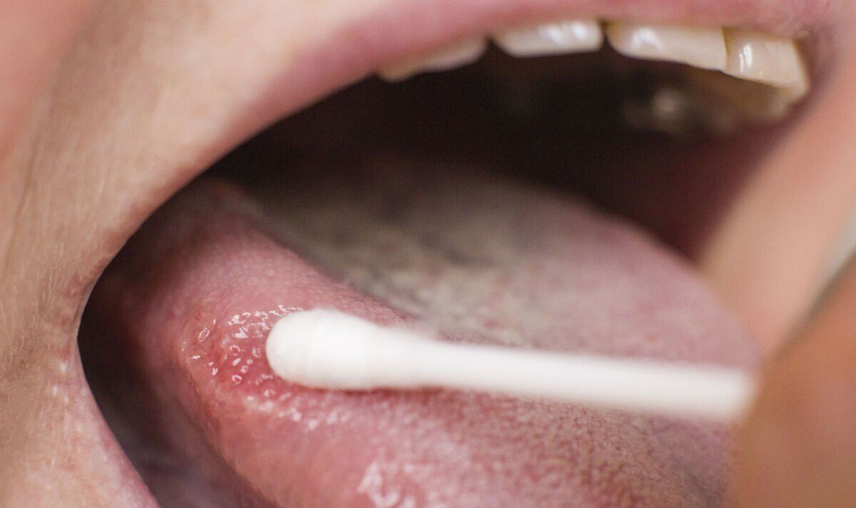 ‘Erythoplakia’ in the mouth that could signal a high cancer risk