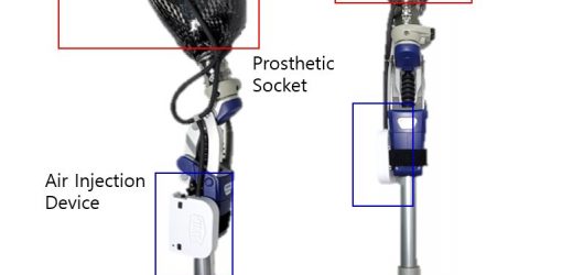 AI-based prosthetic socket developed to help thigh amputees