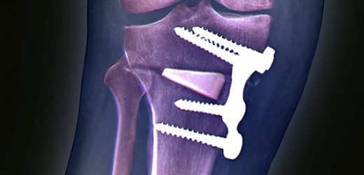 Arthritis experts call for 10k NHS patients to be offered knee op