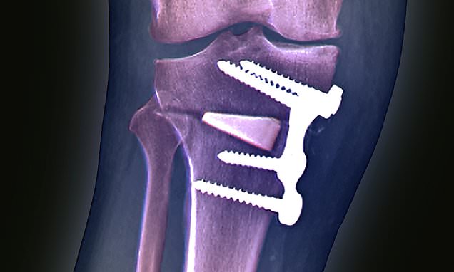 Arthritis experts call for 10k NHS patients to be offered knee op