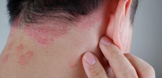 Cardiovascular risk in psoriasis, the association between psoriatic inflammation and atherosclerosis, and the cardiovascular-risk-reducing effects of biologics