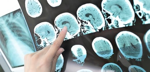 Dual antiplatelet therapy for minor or a warning stroke is underused especially among women