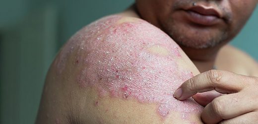 Elevated PCSK9-Psoriasis Link: A New Target for Treatment?
