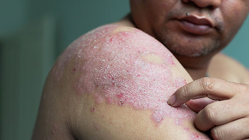 Elevated PCSK9-Psoriasis Link: A New Target for Treatment?