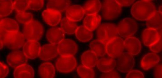 New biomarker for disease progression in multiple sclerosis