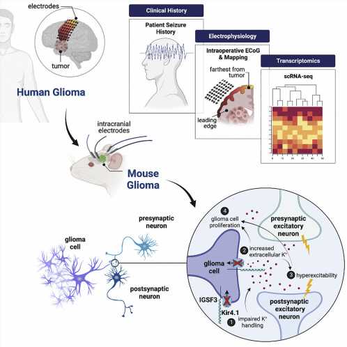 New insights into the drivers of glioma-related epilepsy