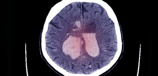 Thrombectomy Benefits Stroke With Large Core Volumes: SELECT2