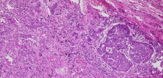 Chemo Doesn’t Improve Lung Adenocarcinoma Survival in Most