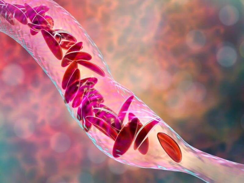 Hydroxyurea underused in youth with sickle cell