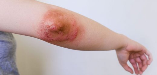 Lebrikizumab Monotherapy Safe, Effective for AD During Induction