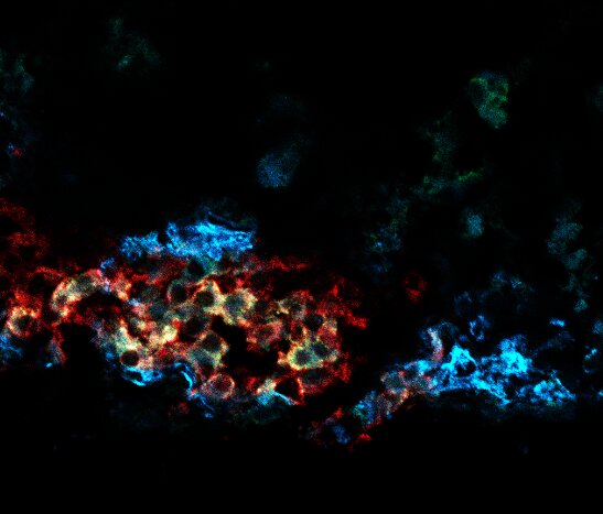 Losing a key type of pancreatic cell may contribute to diabetes