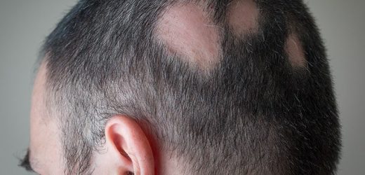 New JAK Inhibitor Study Data Confirm Benefit in Alopecia Areata