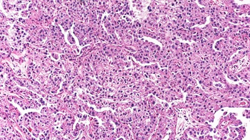 New Role for Olaparib in BRCA Ovarian Cancer in Neoadjuvant Setting