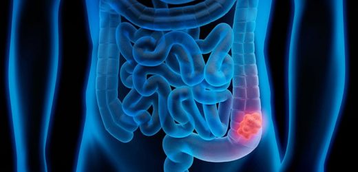 New Trials in Colorectal Cancer: Could Your Patient Benefit?