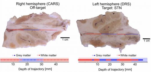 Spectroscopy probe could enhance deep brain stimulation procedure for Parkinson’s