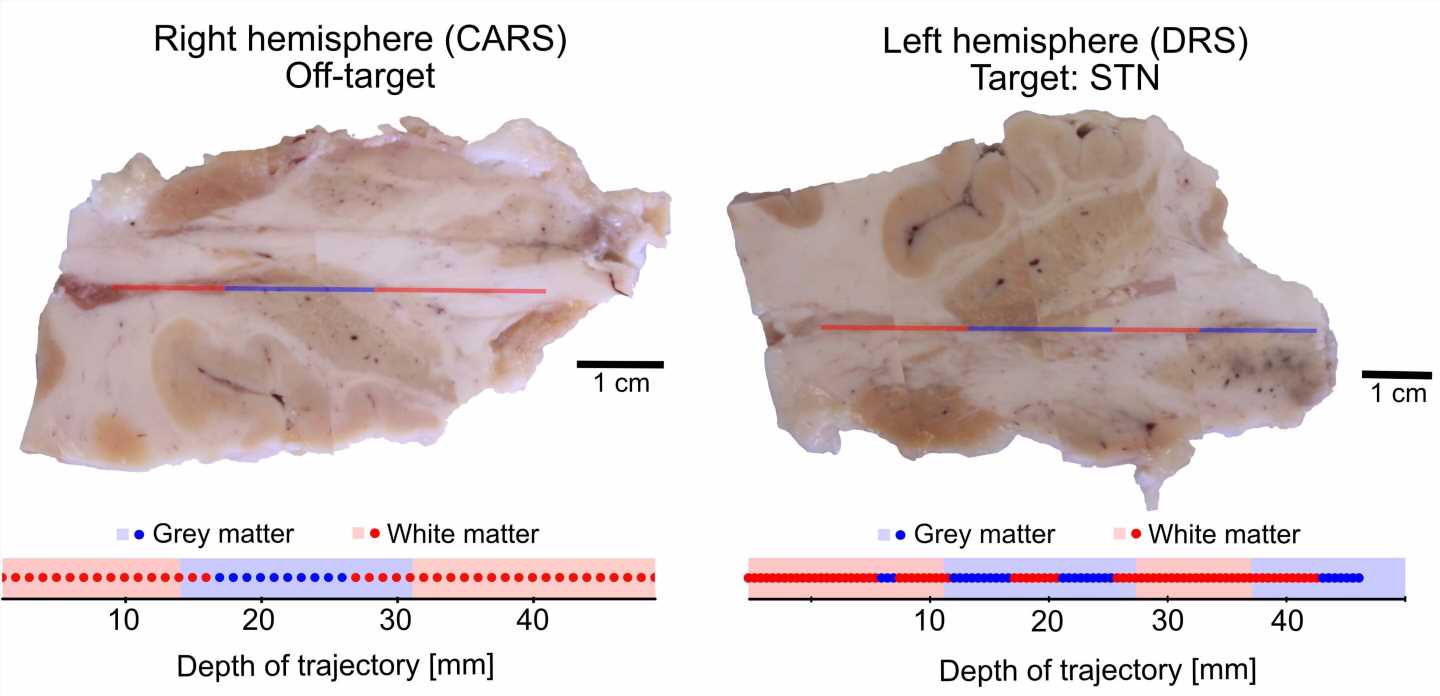 Spectroscopy probe could enhance deep brain stimulation procedure for Parkinson’s