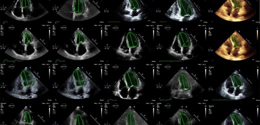 AI Challenges Sonographers in Heart Function Assessment