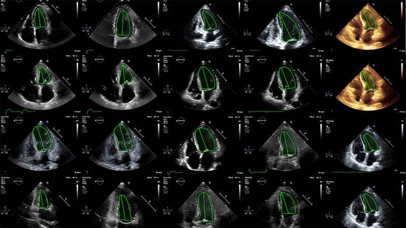 AI Challenges Sonographers in Heart Function Assessment