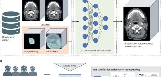 AI algorithm may help better guide oropharynx cancer treatment