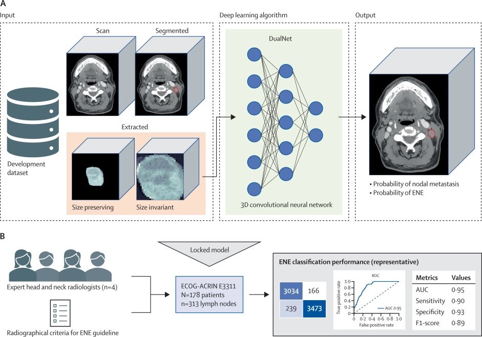 AI algorithm may help better guide oropharynx cancer treatment