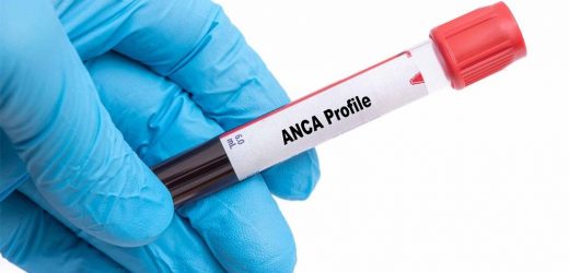 Association of alleles with risk of relapse in ANCA-associated vasculitis in the Japanese population
